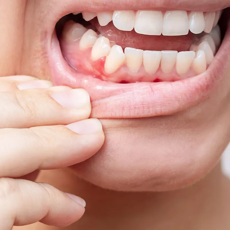 Gum Disease